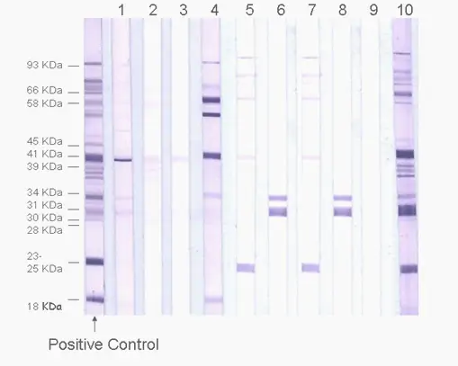 Example of Western Blot test for tick-borne disease testing