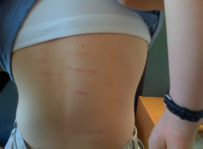 Bartonella Rash in Cat-Scratch-Like Pattern