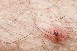 Tick Burrowed in Human Skin Causing Redness