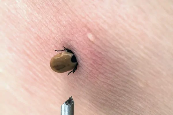 Larger Tick Burrowed in Skin