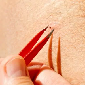 Tweezers Help Pull Out Burrowed Ticks