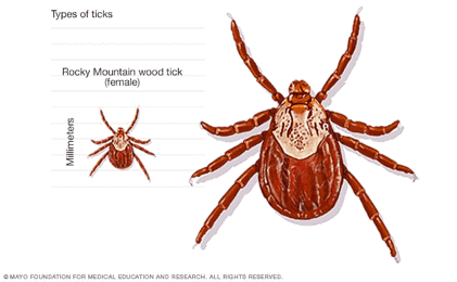 Act Quick to Treat Rocky Mountain Spotted Fever | IGeneX