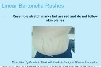 resource-center-bartonella-rashes.jpg